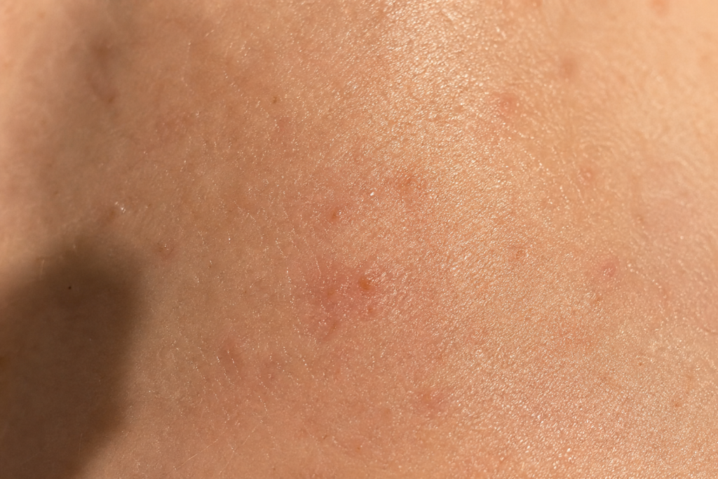 close up of irritated skin